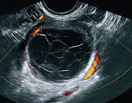 Chist ovarian: simptome, cauze, tratament 